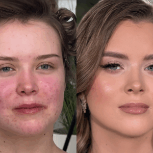 Perfect Cover — cera trądzikowa