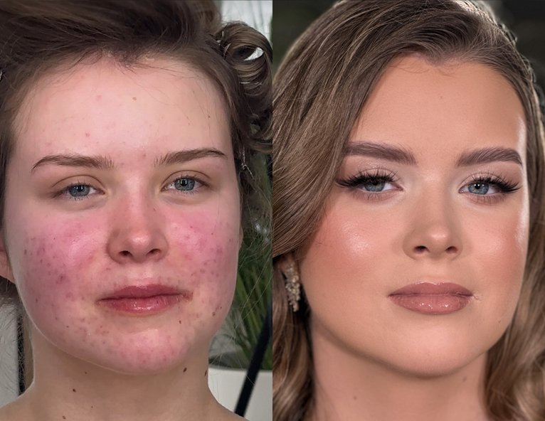 Perfect Cover — cera trądzikowa